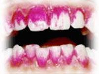 teeth colored with disclosing tablets